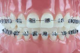 Orthodontics (Regular SS Brackets)